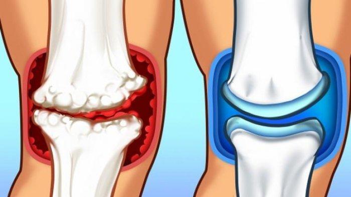 Sel Punca untuk Regenerasi Tulang dan Sendi